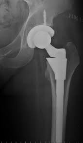 HipImplant lawyers x-ray of hip